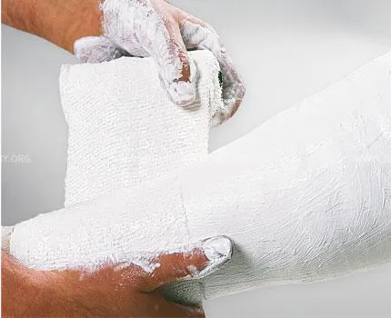 Ligaduras de gesso safix plus 6cmx2m